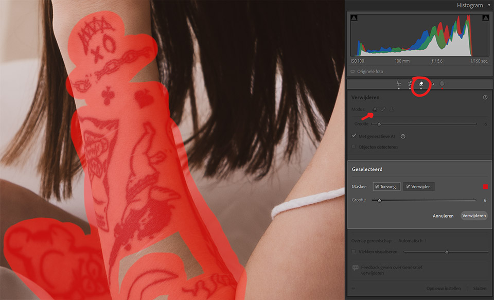 Tatoeage verwijderen Tatoeage verwijderen