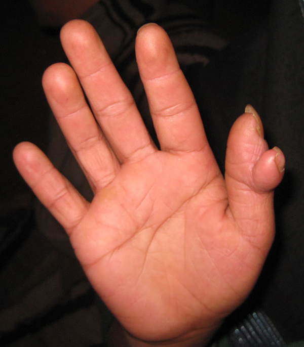 Polydactylie